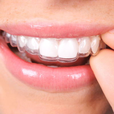 Why retainers are important: keeping your smile straight for life 8 Closeup of a person putting a retainer on, representing why retainers are important